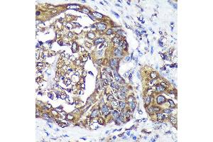 Immunohistochemistry of paraffin-embedded Human lung cancer using  Rabbit pAb (ABIN7265603) at dilution of 1:100 (40x lens). (ANKLE2 抗体  (AA 350-450))
