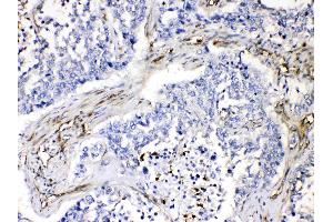 VASP was detected in paraffin-embedded sections of human lung cancer tissues using rabbit anti- VASP Antigen Affinity purified polyclonal antibody (Catalog # ) at 1 µg/mL. (VASP 抗体  (N-Term))