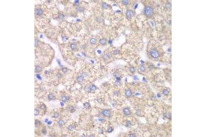 Immunohistochemistry of paraffin-embedded human liver injury using ACAT1 antibody. (ACAT1 抗体  (AA 1-145))