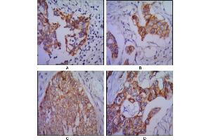Immunohistochemical analysis of paraffin-embedded human lung cancer (A), colon cancer (B), ovarian cancer (C) and mammary cancer(D), using CDH2 mouse mAb with DAB staining. (N-Cadherin 抗体)