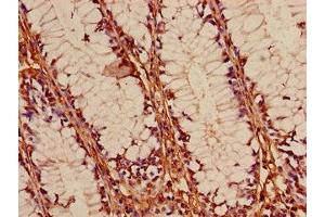 Immunohistochemistry of paraffin-embedded human colon cancer using ABIN7153058 at dilution of 1:100 (Foxk1 抗体  (AA 621-730))