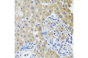Immunohistochemistry of paraffin-embedded human liver injury using RHOB antibody (ABIN5975835) at dilution of 1/100 (40x lens). (RHOB 抗体)