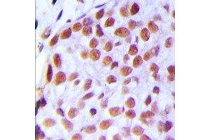 Immunohistochemical analysis of TAF5L staining in human breast cancer formalin fixed paraffin embedded tissue section. (TAF5L 抗体)