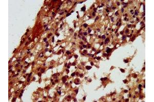 IHC image of ABIN7167616 diluted at 1:300 and staining in paraffin-embedded human melanoma performed on a Leica BondTM system. (RGS6 抗体  (AA 177-262))