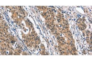 Immunohistochemistry of paraffin-embedded Human gastric cancer tissue using BNIP3L Polyclonal Antibody at dilution 1:40 (BNIP3L/NIX 抗体)