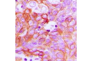 Immunohistochemical analysis of Ephrin A1 staining in human breast cancer formalin fixed paraffin embedded tissue section. (Ephrin A1 抗体  (Center))