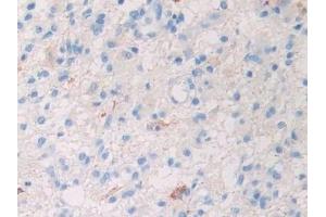 Detection of Slit1 in Human Glioma Tissue using Polyclonal Antibody to Slit Homolog 1 (Slit1)