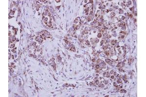 IHC-P Image Immunohistochemical analysis of paraffin-embedded human breast cancer, using MUSK, antibody at 1:250 dilution. (MUSK 抗体  (N-Term))