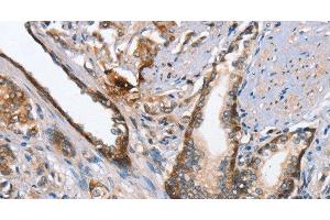 Immunohistochemistry of paraffin-embedded Human prostate cancer using MAD2L1BP Polyclonal Antibody at dilution of 1:65 (MAD2L1BP 抗体)