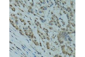 Immunohistochemistry of paraffin-embedded Human colon carcinoma using GABPA Polyclonal Antibody at dilution of 1:100 (40x lens). (GABPA 抗体)