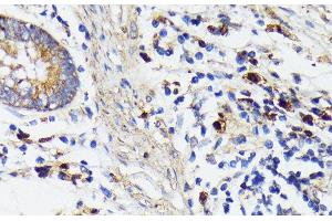 Immunohistochemistry of paraffin-embedded Human colon carcinoma using TREM2 Polyclonal Antibody at dilution of 1:200 (40x lens). (TREM2 抗体)