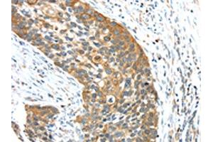 The image on the left is immunohistochemistry of paraffin-embedded Human esophagus cancer tissue using ABIN7131474(TRIM16 Antibody) at dilution 1/35, on the right is treated with fusion protein. (TRIM16 抗体)