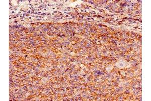 Immunohistochemistry of paraffin-embedded human pancreatic cancer using ABIN7154773 at dilution of 1:100 (GBP2 抗体  (AA 100-259))