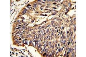IHC analysis of FFPE human lung carcinoma stained with MyD88 antibody (MYD88 抗体  (AA 136-164))