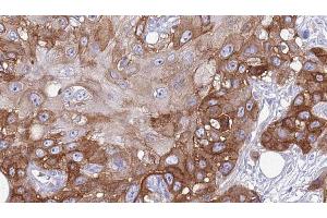 ABIN6274028 at 1/100 staining Human Head and neck cancer tissue by IHC-P. (PD-1 抗体  (Internal Region))