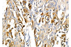ABIN6264786 and ABIN6278631 at 1/100 staining Human esophageal cancer by IHC-P. (RNF19A 抗体  (N-Term))