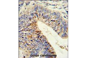 Formalin-fixed and paraffin-embedded human colon carcinoma reacted with ADAMDEC1 Antibody (N-term), which was peroxidase-conjugated to the secondary antibody, followed by DAB staining.