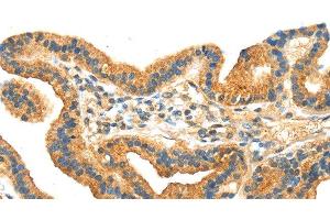 Immunohistochemistry of paraffin-embedded Human thyroid cancer tissue using RRAGA Polyclonal Antibody at dilution 1:30 (RRAGA 抗体)