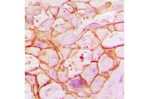 Immunohistochemical analysis of ARALAR1 staining in human breast cancer formalin fixed paraffin embedded tissue section.