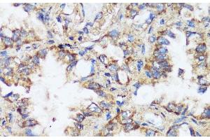 Immunohistochemistry of paraffin-embedded Human lung cancer using ERK1 / ERK2 Polyclonal Antibody at dilution of 1:200 (40x lens). (ERK1/2 抗体)