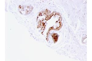 Formalin-fixed, paraffin-embedded human Prostate Carcinoma stained with p57 Mouse Monoclonal Antibody (57P06). (CDKN1C 抗体)