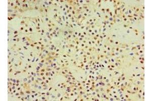 Immunohistochemistry of paraffin-embedded human breast cancer using ABIN7149492 at dilution of 1:100 (DACT3 抗体  (AA 1-160))
