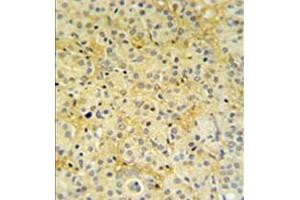 Formalin fixed, paraffin embedded prostate carcinoma stained with DAZAP2 Antibody (C-term) followed by peroxidase conjugation of the secondary antibody and DAB staining. (DAZAP2 抗体  (C-Term))