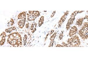 Immunohistochemistry of paraffin-embedded Human esophagus cancer tissue using FOXG1 Polyclonal Antibody at dilution of 1:60(x200) (FOXG1 抗体)