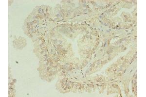 Immunohistochemistry of paraffin-embedded human prostate cancer using ABIN7155120 at dilution of 1:100 (HNRNPL 抗体  (AA 89-335))