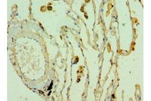 Immunohistochemistry of paraffin-embedded human lung cancer using ABIN7171841 at dilution of 1:100 (CLEC3B 抗体  (AA 22-202))