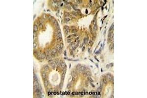 ARL8A Antibody (Center) immunohistochemistry analysis in formalin fixed and paraffin embedded human prostate carcinoma followed by peroxidase conjugation of the secondary antibody and DAB staining. (ARL8A 抗体  (Middle Region))