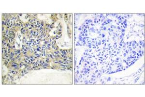 Immunohistochemistry analysis of paraffin-embedded human breast carcinoma tissue using PKC theta (Phospho-Ser695) antibody. (PKC theta 抗体  (pSer695))
