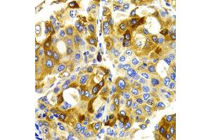 Immunohistochemistry of paraffin-embedded human liver cancer using CDK20 antibody (ABIN5971446) at dilution of 1/100 (40x lens). (CCRK 抗体)