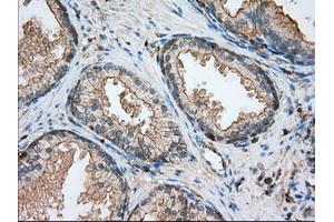 Immunohistochemical staining of paraffin-embedded Adenocarcinoma of ovary tissue using anti-ALDH3A1 mouse monoclonal antibody. (ALDH3A1 抗体)