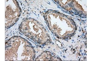 Immunohistochemical staining of paraffin-embedded Adenocarcinoma of ovary tissue using anti-ALDH3A1 mouse monoclonal antibody.