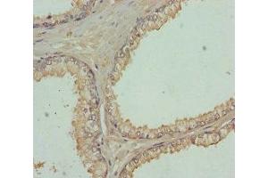 Immunohistochemistry of paraffin-embedded human prostate cancer using ABIN7152450 at dilution of 1:100
