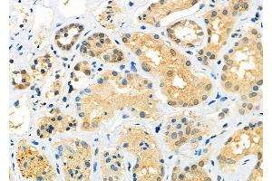 ABIN6260357 and ABIN6273203 at 1/100 staining Human kidney cancer and adjacent normal tissues by IHC-P. (C14orf166 抗体)