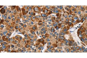 Immunohistochemistry of paraffin-embedded Human liver cancer tissue using SLAMF8 Polyclonal Antibody at dilution 1:40 (SLAMF8 抗体)