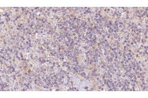 ABIN6273103 at 1/100 staining Human lymph cancer tissue by IHC-P. (Coq7 抗体  (Internal Region))