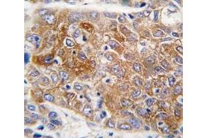 IHC analysis of FFPE human hepatocarcinoma tissue stained with ALDH1L1 antibody (ALDH1L1 抗体  (AA 717-746))