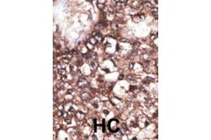Formalin-fixed and paraffin-embedded human cancer tissue reacted with the primary antibody, which was peroxidase-conjugated to the secondary antibody, followed by DAB staining. (LRP8 抗体  (C-Term))