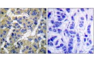 Immunohistochemistry analysis of paraffin-embedded human breast carcinoma, using Keratin 8 (Phospho-Ser73) Antibody.