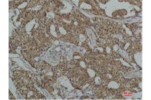 Immunohistochemistry (IHC) analysis of paraffin-embedded Human Breast Carcicnoma using HSC70 Mouse Monoclonal Antibody diluted at 1:200. (Hsc70 抗体)