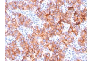 Formalin-fixed, paraffin-embedded human Breast Carcinoma stained with HER-2 Mouse Monoclonal Antibody (ERBB2/3079). (ErbB2/Her2 抗体  (AA 311-462))