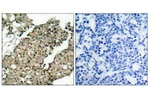 Immunohistochemical analysis of paraffin-embedded human breast carcinoma tissue using G3BP-1 (phospho-Ser232) antibody (E021102).
