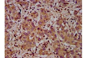 IHC image of ABIN7150047 diluted at 1:400 and staining in paraffin-embedded human liver cancer performed on a Leica BondTM system.