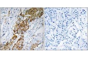 Immunohistochemistry analysis of paraffin-embedded human breast carcinoma tissue, using USP32 Antibody. (USP32 抗体  (AA 271-320))