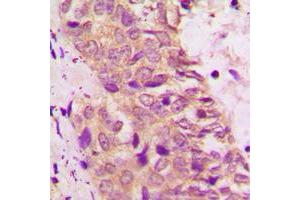 Immunohistochemical analysis of BAD staining in human prostate cancer formalin fixed paraffin embedded tissue section. (BAD 抗体  (C-Term))