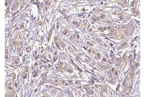 ABIN6267655 at 1/100 staining human Breast carcinoma tissue sections by IHC-P.