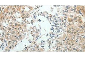 Immunohistochemistry of paraffin-embedded Human lung cancer using NDRG2 Polyclonal Antibody at dilution of 1:50 (NDRG2 抗体)